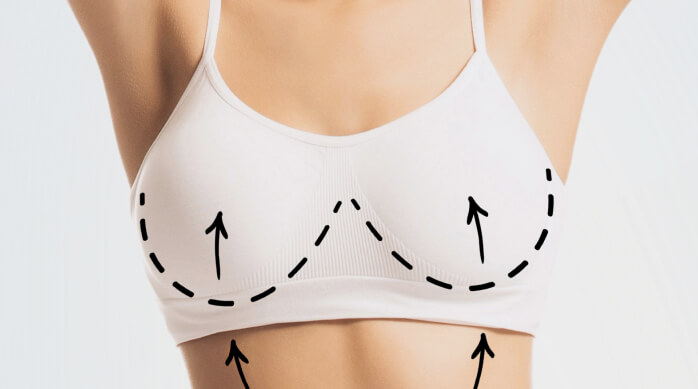 Breast Lift