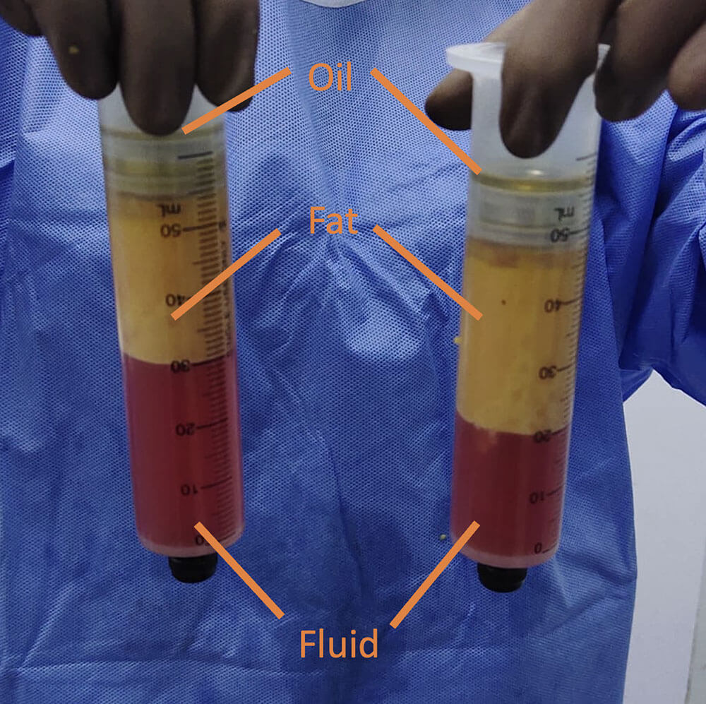 Fat Transfer