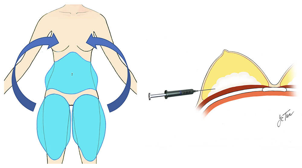 Fat Transfer