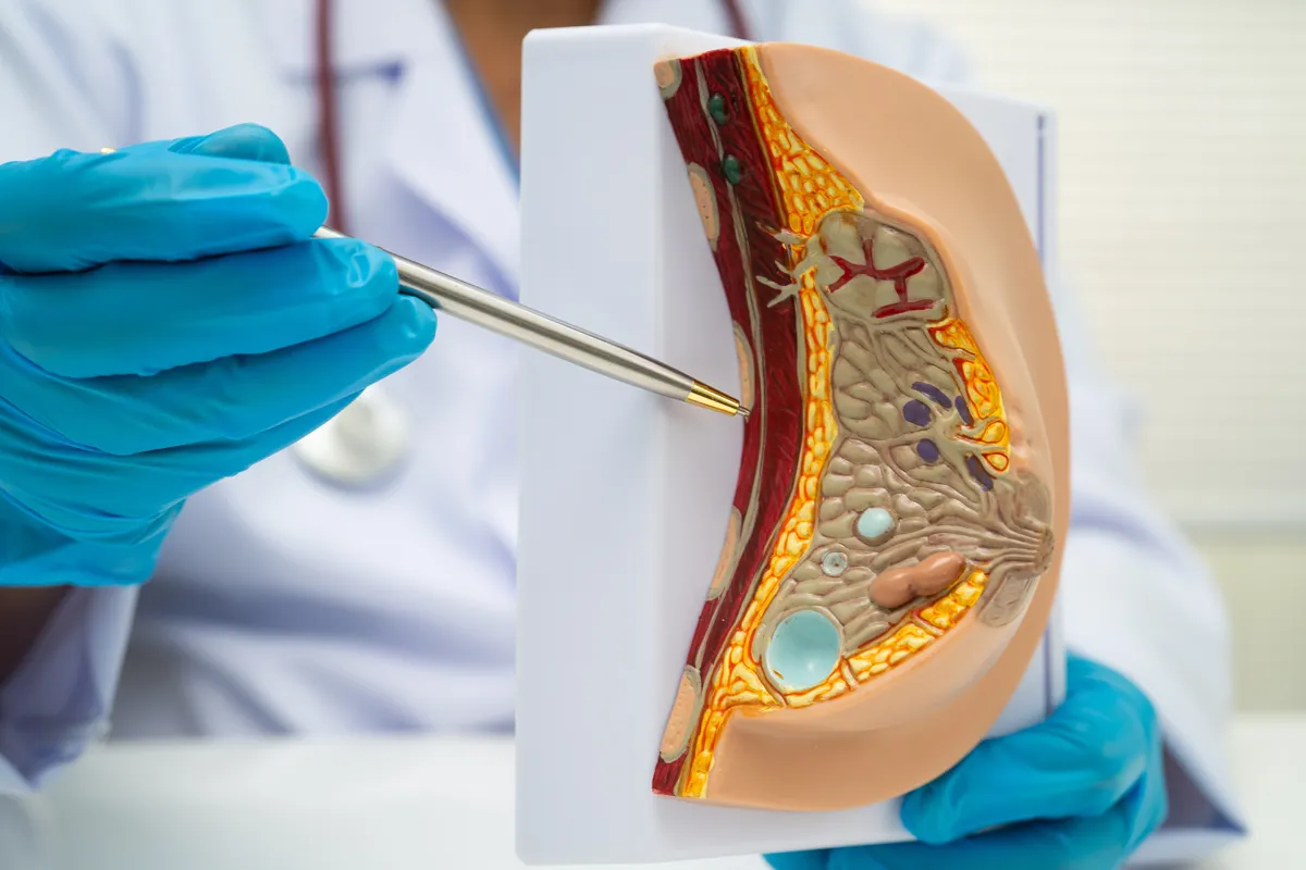 Doctor pointing to a cross-sectional breast anatomy model during a medical explanation